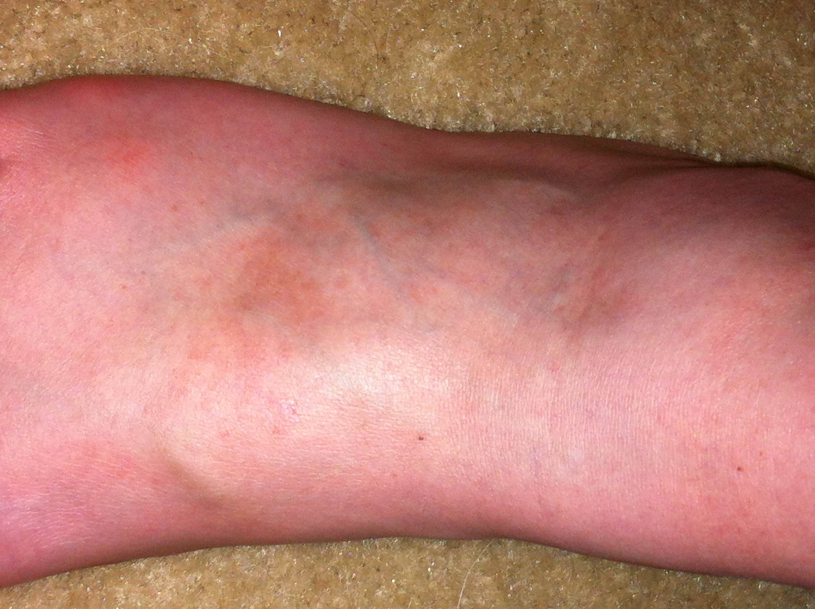 Foot rash - RightDiagnosis.com