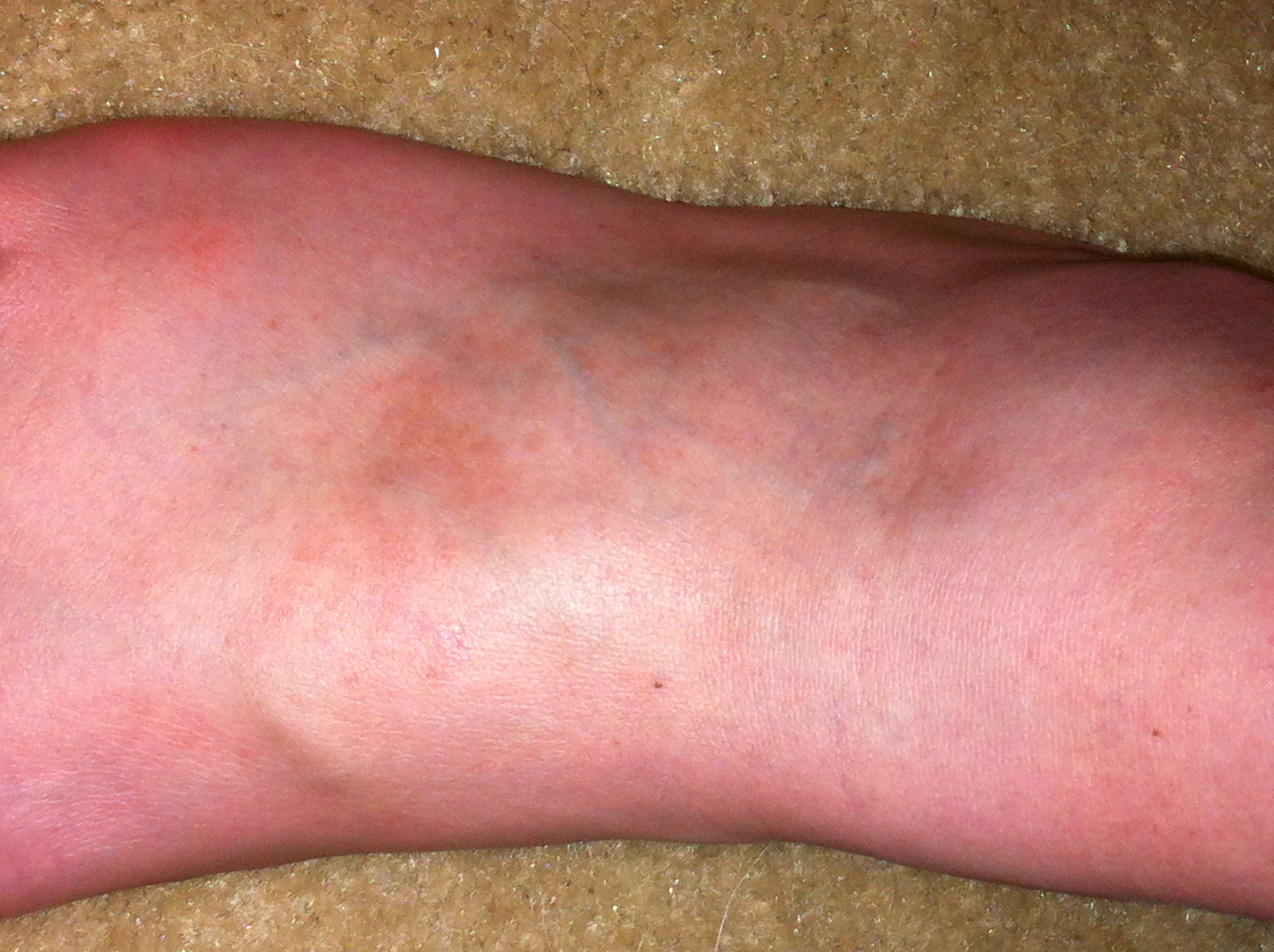 Skin Rashes On Feet Pictures