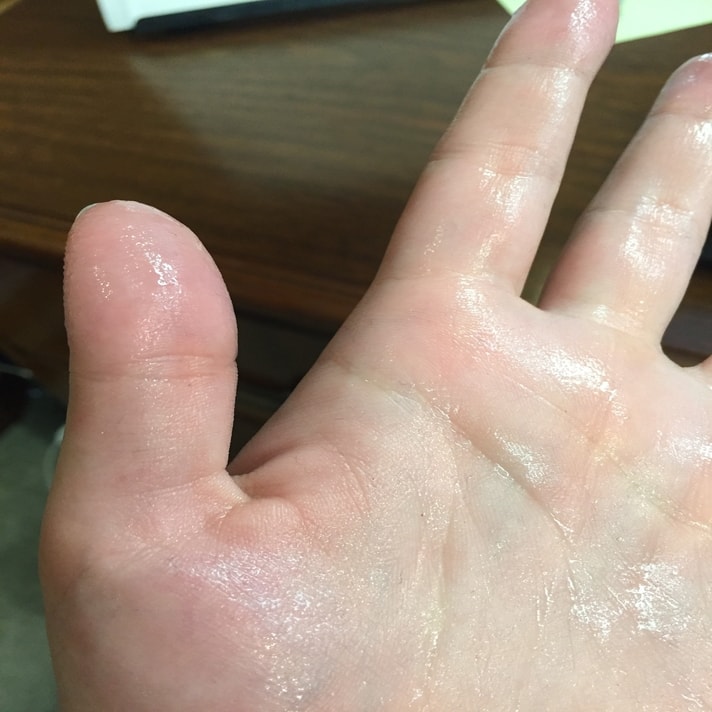 sweaty hand also known as palmar hyperhidrosis